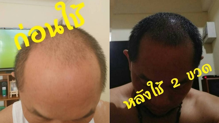 รีวิว ยาปลูกผม ถาวร ยาปลูกผมราคาดีสุดๆ เห็นผลจริง 100%